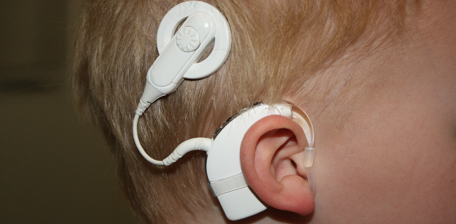 Erg_Medical_Cochlear_Ear.JPG