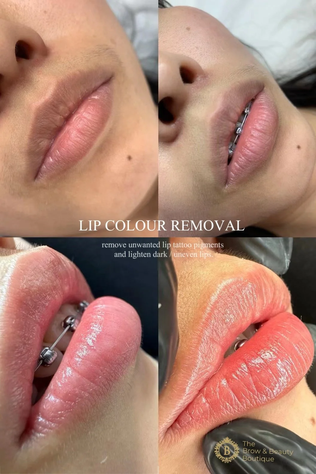 My Lips Look Too Dark Now—Can They Be Softened to a Natural Shade ...
