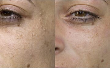 Hard White Facial Bumps: When Milia Requires More Than Manual Extraction