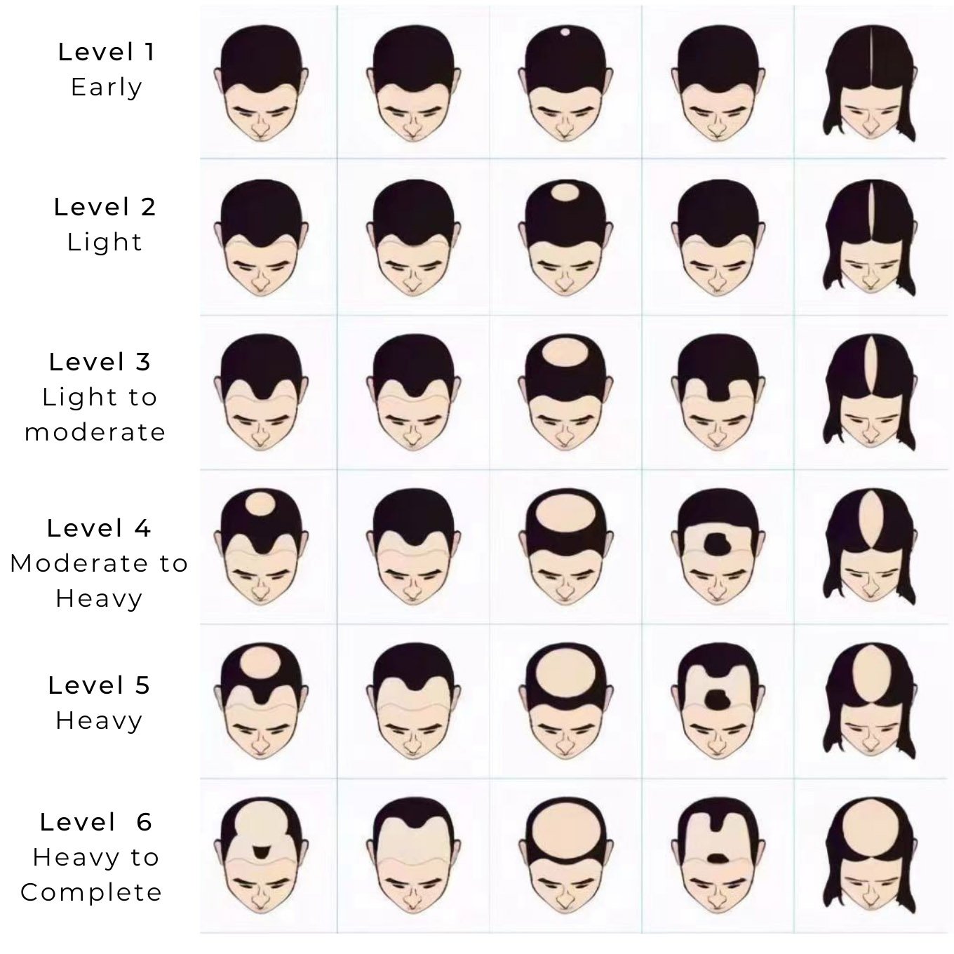 stages-of-hairloss.jpg