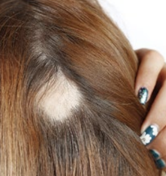 Patchy Hairloss Alopecia Areata