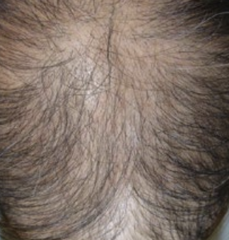 Diffused Hair Thinning