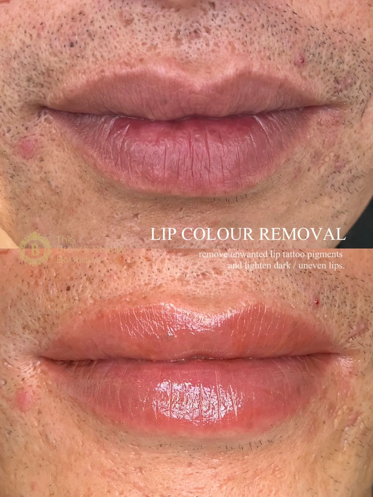 Lip Colour Removal Before & After (2).JPG