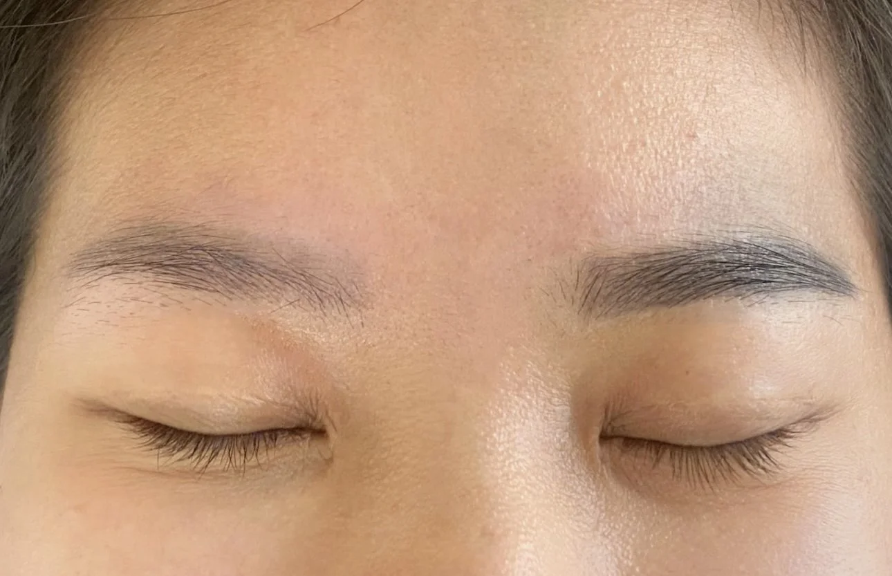 Laser Eyebrow Removal vs. RF Revival : Understanding the Key Differences