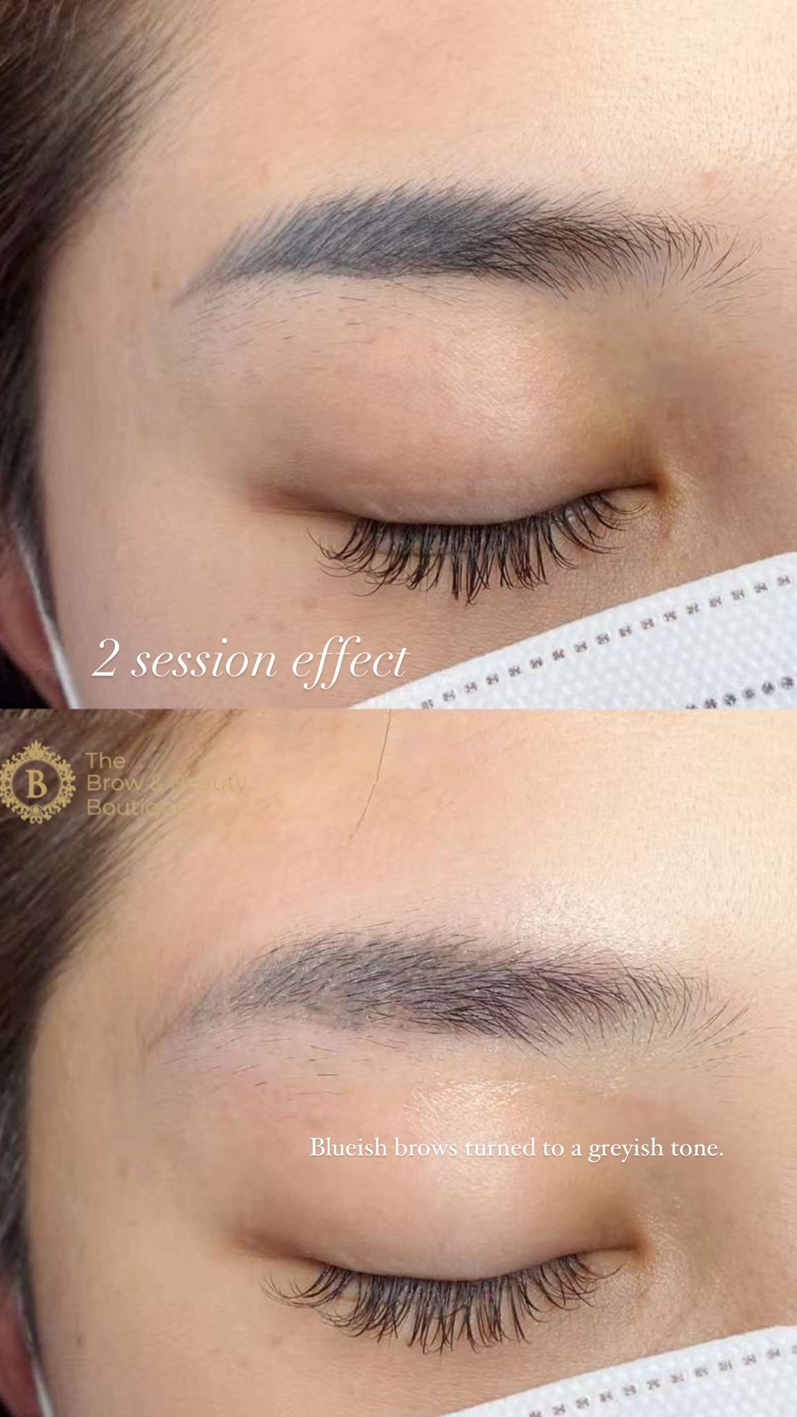 The Growing Demand for Safe Eyebrow Correction in 2025