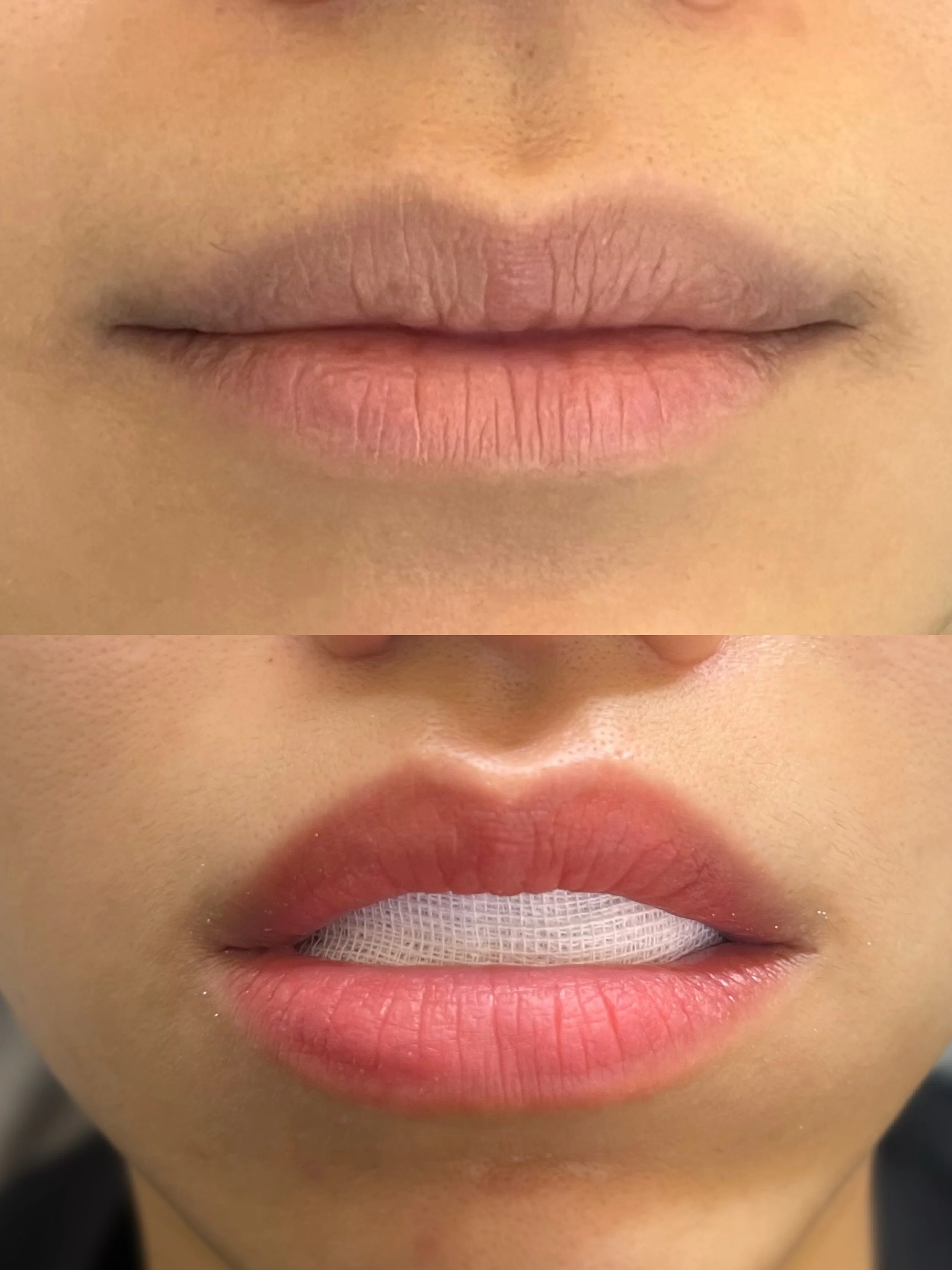 Lip_Enhancement_Before & After_8771.JPG