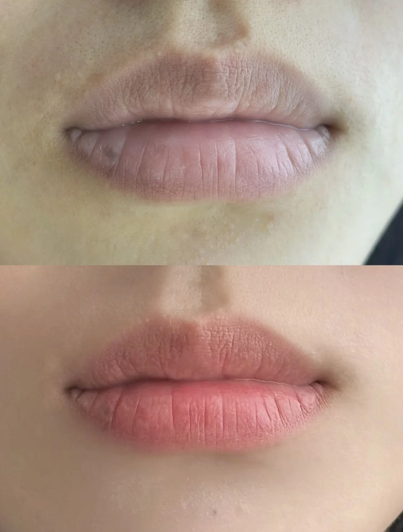 Lip_Enhancement_before &. after 57d8d45282208605b1c69a1efc01d4c3.jpg