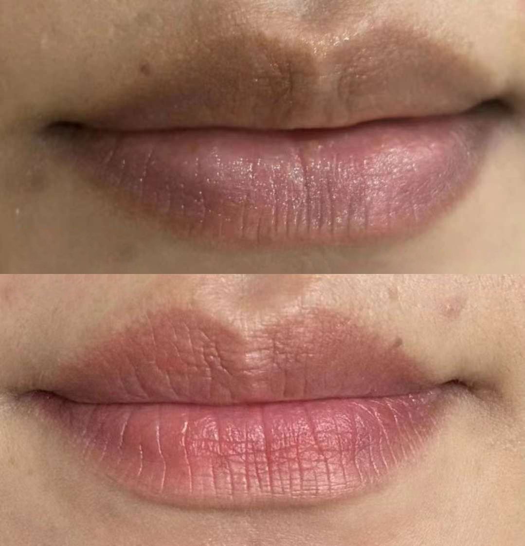 Lip_Enhancement_Before & After_e584075144f926fe2d3064efd69024ef.jpg