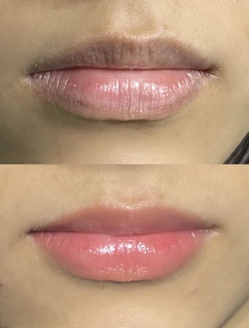 after effects imporeiting c lips black HOW I FINALLY LIGHTENED MY DARK PERMANENTLY + answering some of your questions #liplightening Dry And Cracked Lips Vitamin
