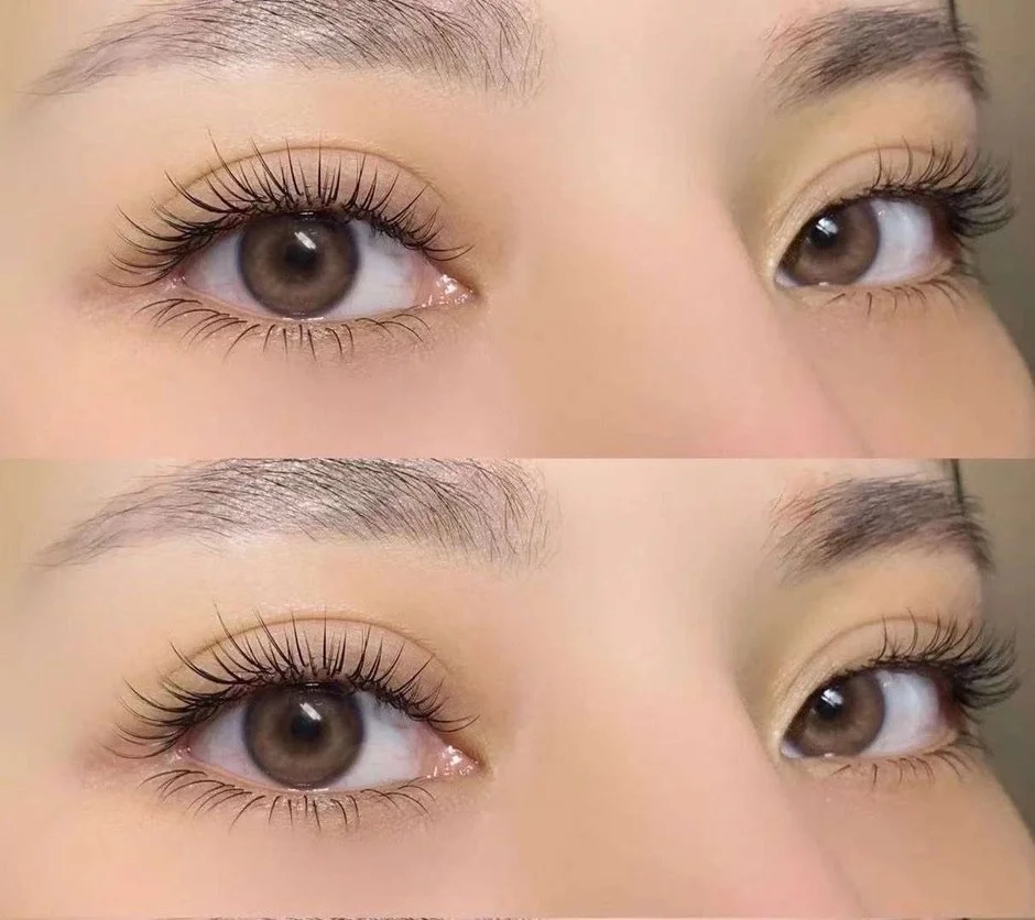 Eyelash Regrowth When Lash Density Declines Faster Than Scalp Hair