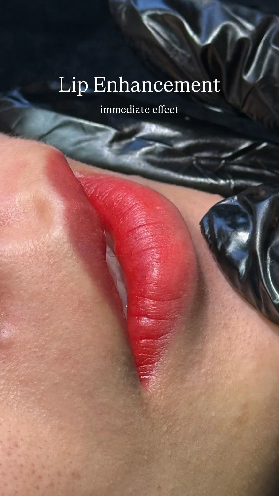 Lip Enhancement (1).jpeg