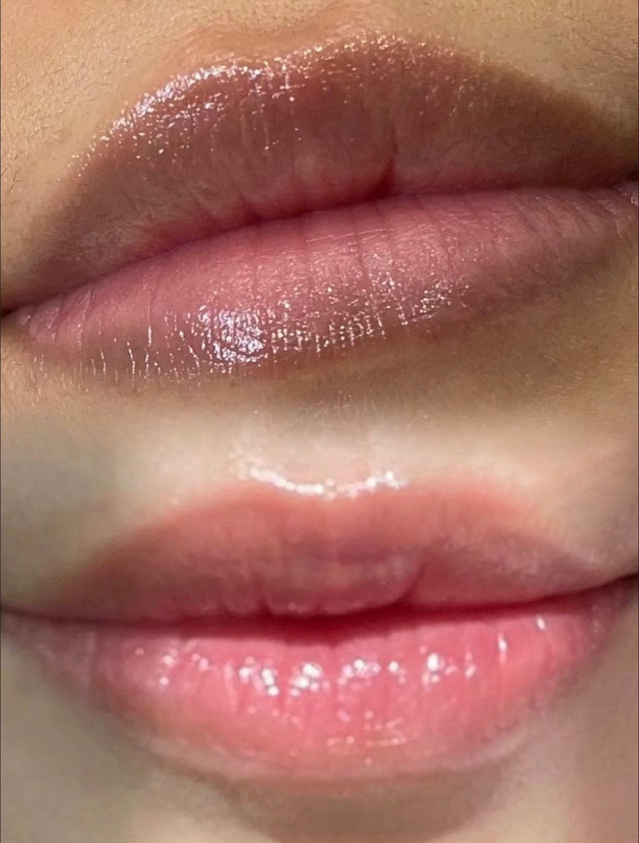 Lip_Enhancement_ before & after 28e95ab2eb84f75f690b816b8b9890e0.JPG