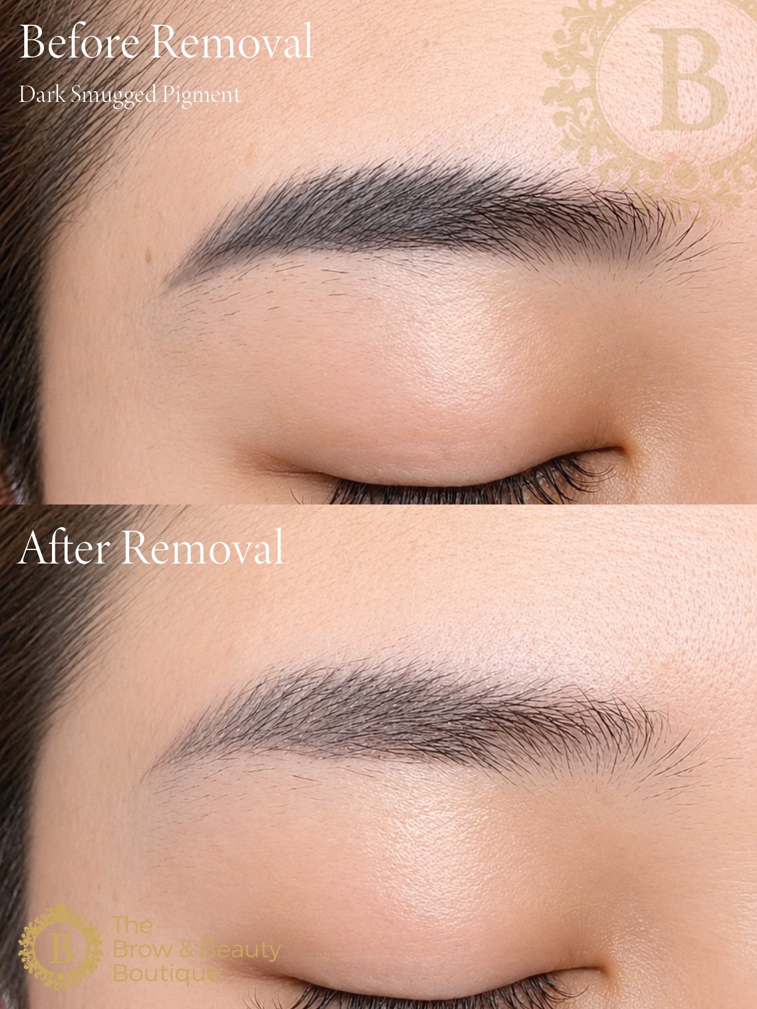 RF PULSE eyebrow Removal by The Brow & Beauty Boutique6.jpg