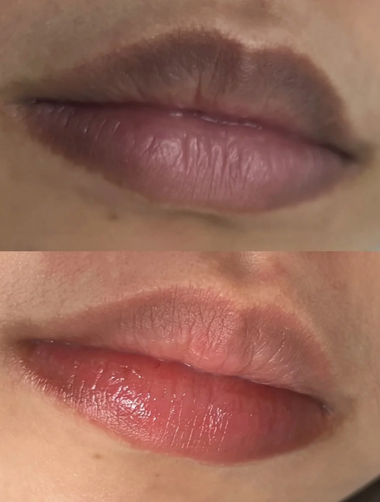 Lip_EnhancementLip enhancementf eb417bef815af26aa7f9d4fdfad1d8.JPG