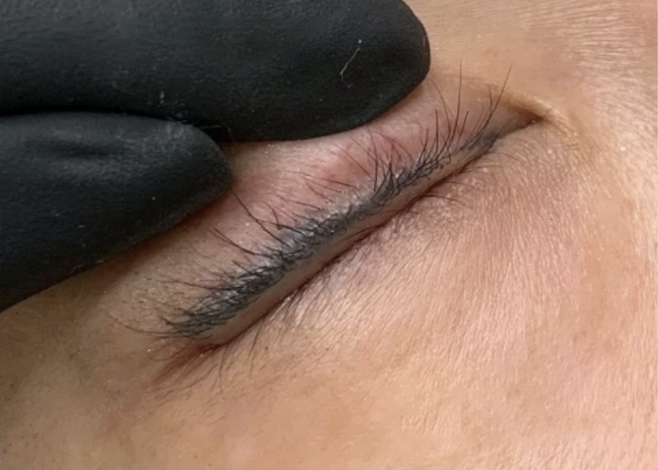 Yes, Thick Eyeliner Can Be Corrected: A Periocular Pigment Reduction and Re-Embroidery Approach