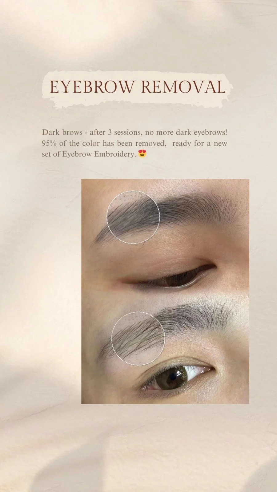 The Science Behind Our Eyebrow Removal Technology