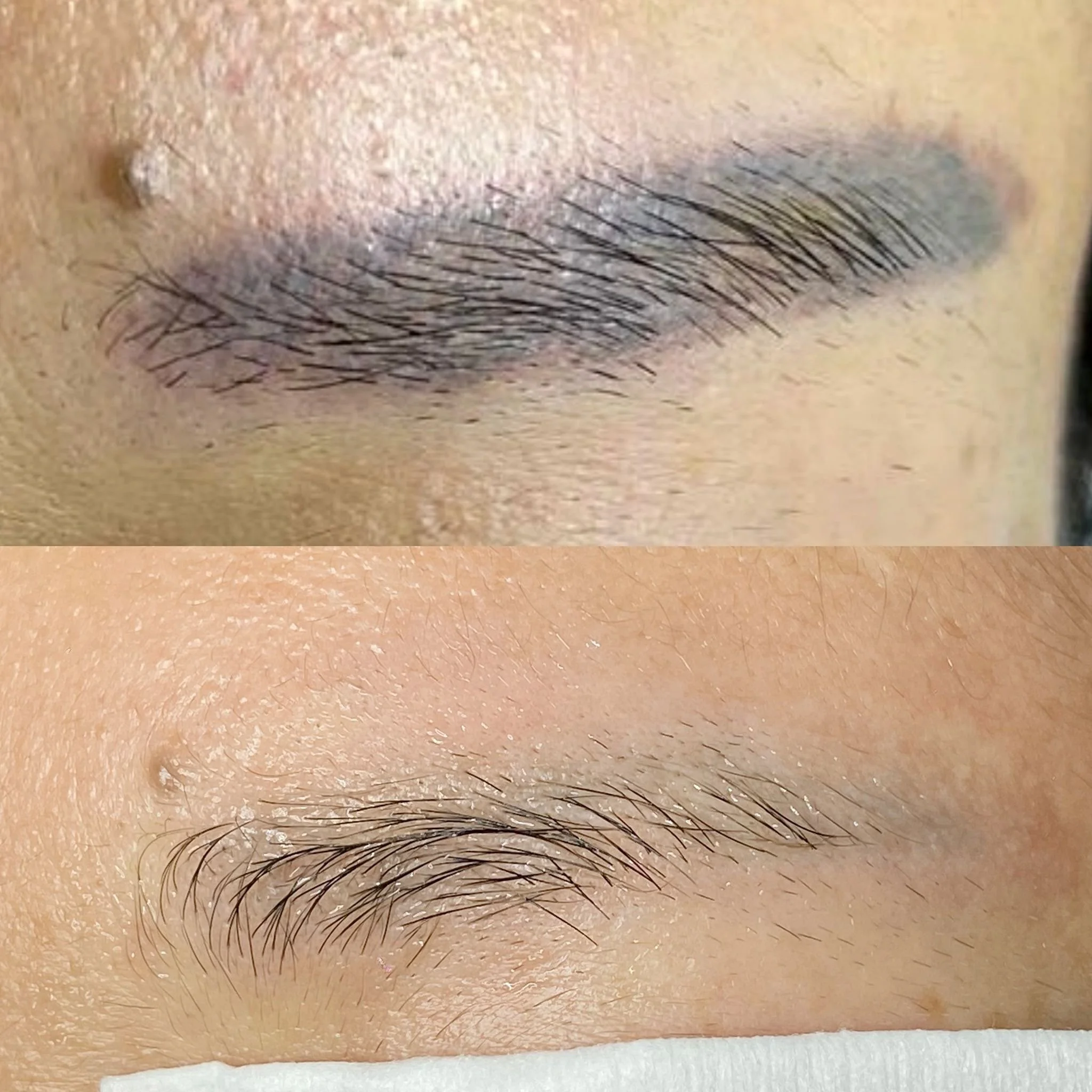 Top 5 Things You Need to Know About Eyebrow Tattoo Removal