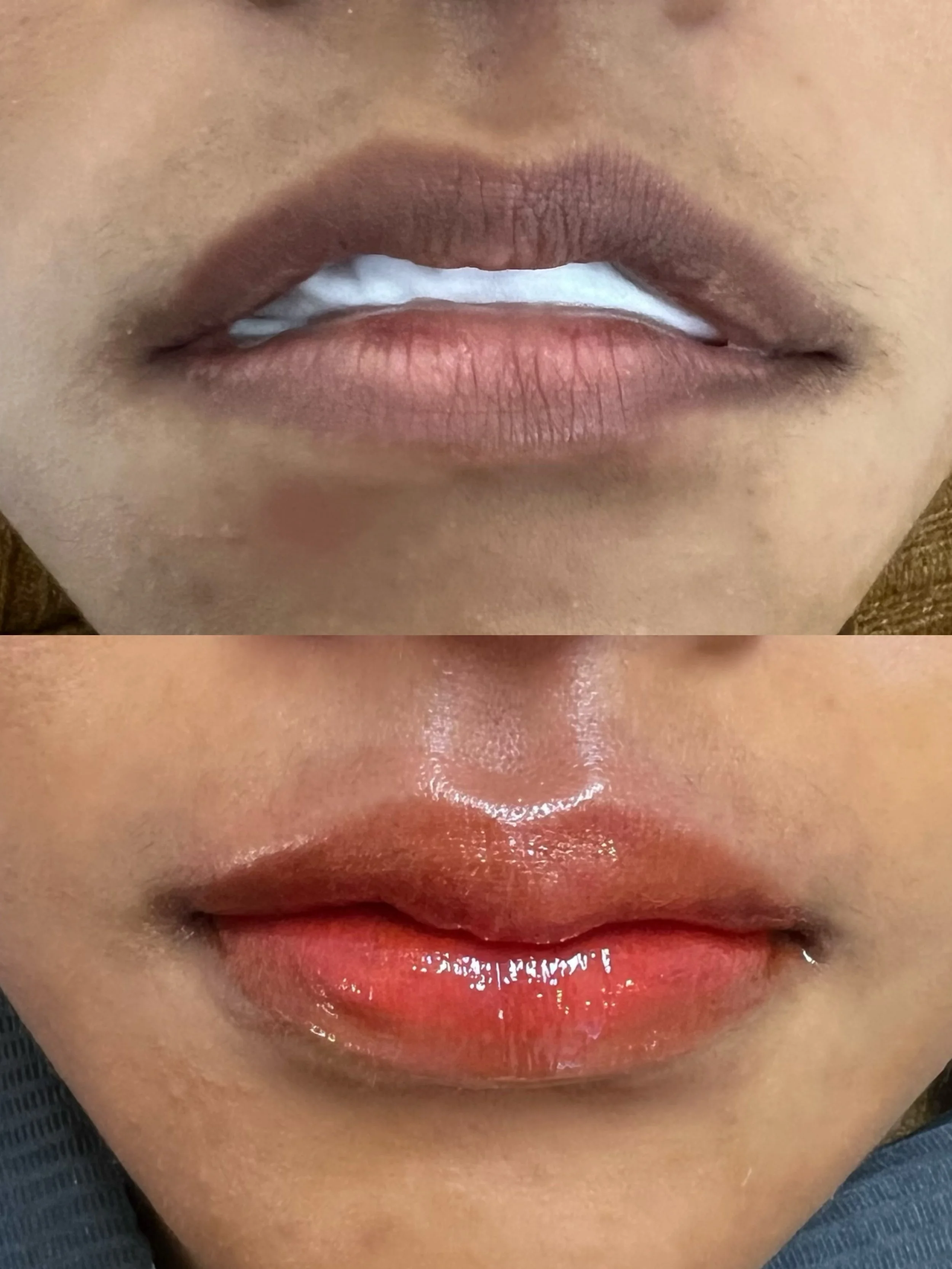 Lip_Enhancement_Before & After_6124.jpeg