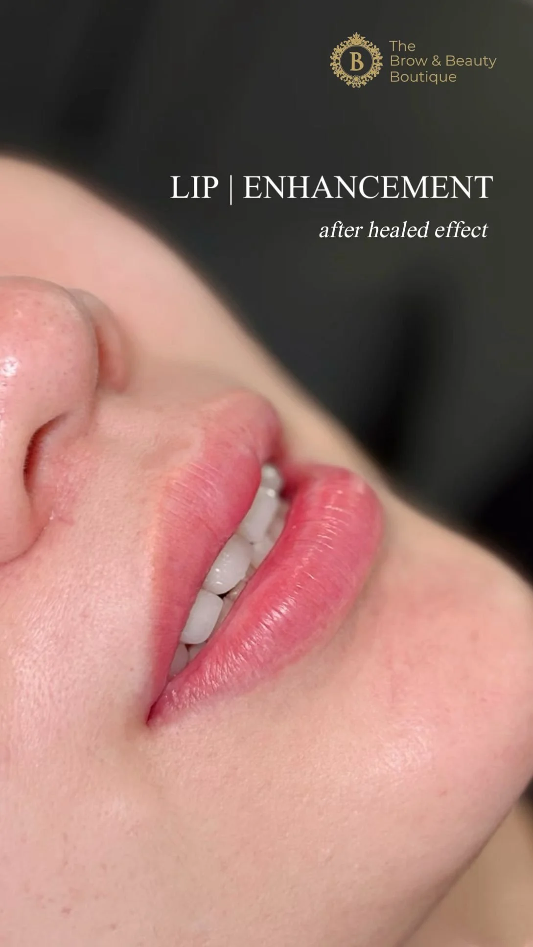 Lip enhancement embroidery showcasing Close-up of a woman's lips and part of her nose, showcasing lip enhancement after healing,  it is from The Brow & Beauty Boutique.