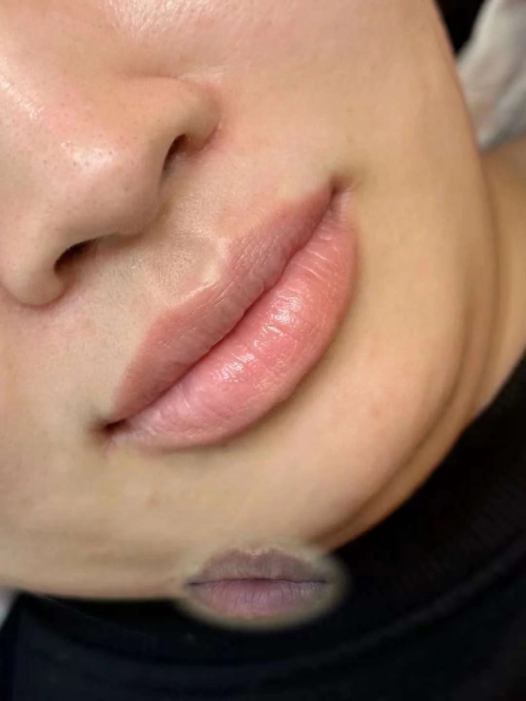 Lip_Enhancement_close up  8787e07c760ab10801ec9f9bbc8e2d95 2.JPG