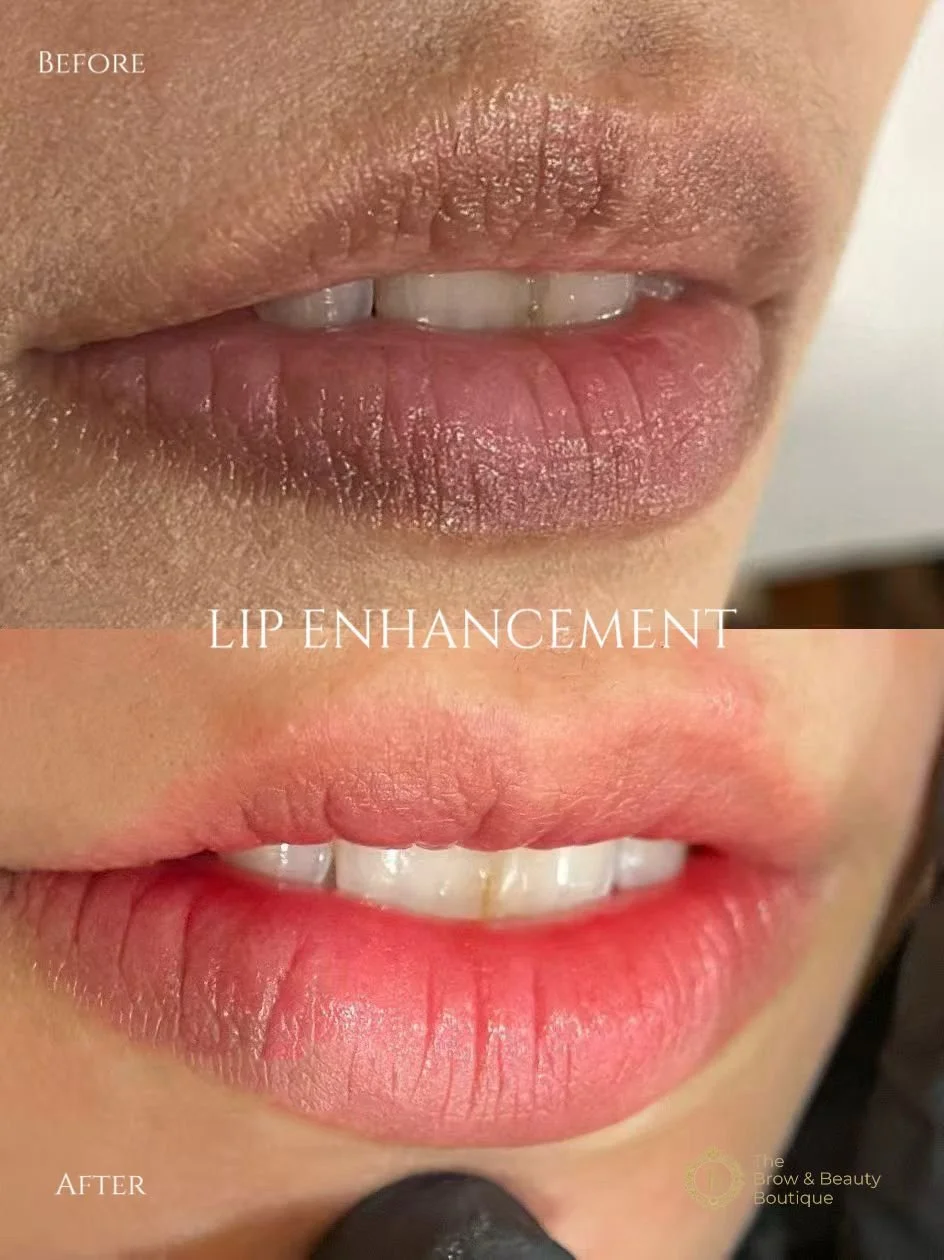 Close-up of lips before and after lip enhancement, showing fuller and more defined lips post-treatment.