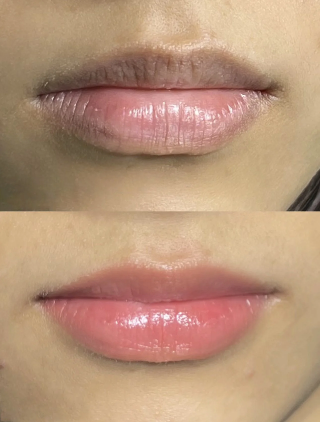 Lip_Enhancement_Before & After_be0815867a996680ec4887b418455173.jpg