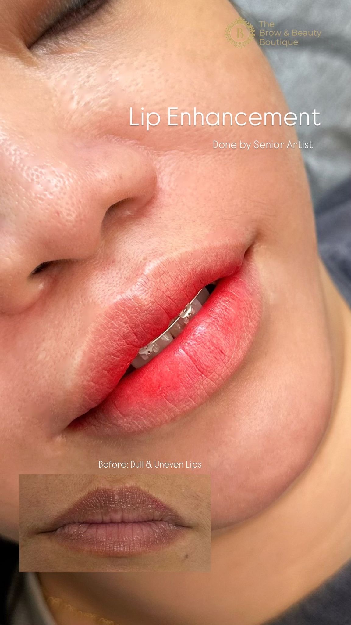 Lip Enhancement.JPG