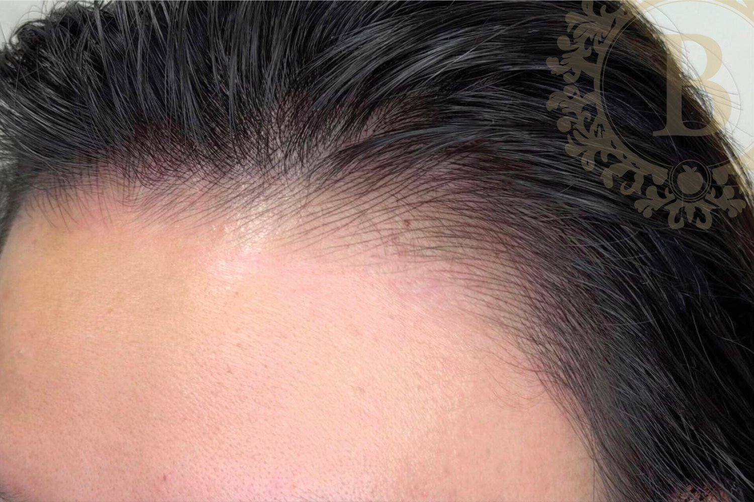How Baby Hairline Embroidery Can Make a Large Forehead Look Smaller