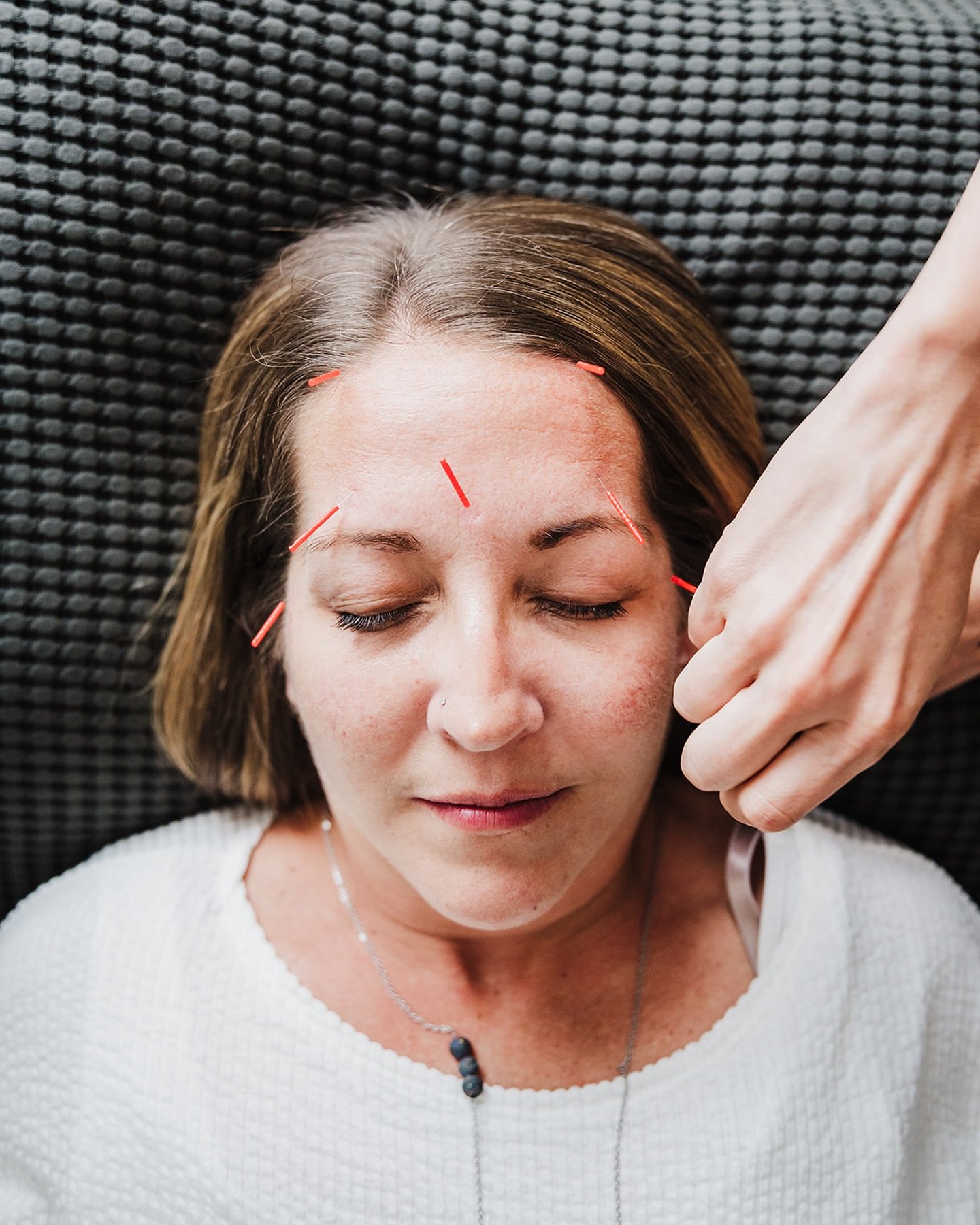 SINUSES + ACUPUNCTURE🍃🍃

How can acupuncture can help with sinus issues?

✨ Reduces Sinus Irritation by decreasing inflammation in the sinuses, relieving congestion and pressure.

✨ Improves Drainage by promoting better circulation and lymphatic fl