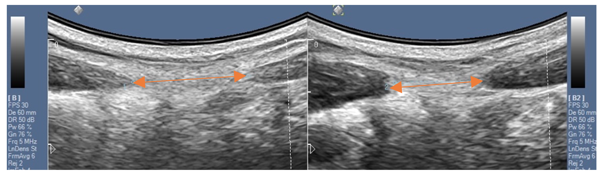 Fysio-Specialist Echografie bij Diastase