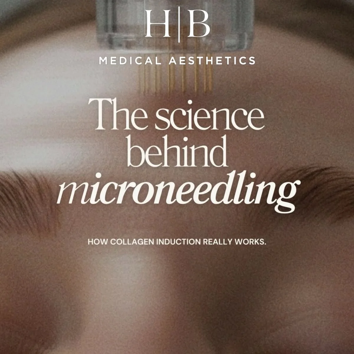 Microneedling works by stimulating the skin&rsquo;s natural repair process.

Using very fine sterile needles, controlled micro-channels are created within the skin. This signals the body to begin a healing response &mdash; increasing collagen, elasti