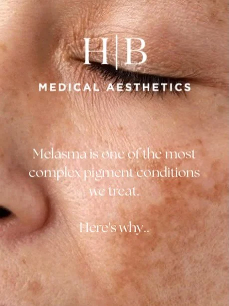 Melasma isn&rsquo;t just pigmentation.

It&rsquo;s a chronic skin condition driven by UV + visible light, hormones, inflammation, and vascular changes&mdash;which is exactly why it can be so frustrating to treat.

You might notice:
&bull; Symmetrical