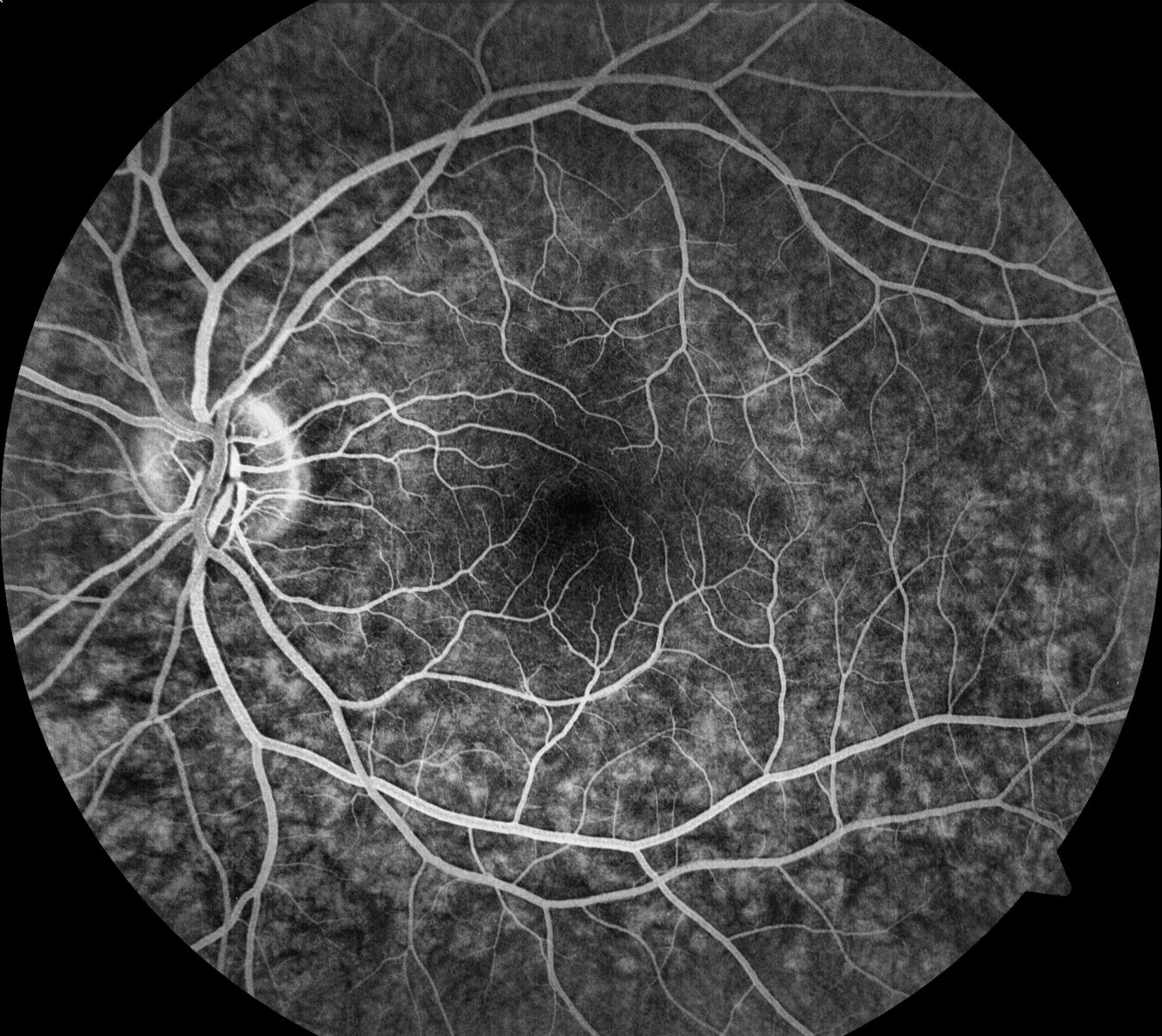 Normal Fa General 3 — Macular Degeneration New Zealand