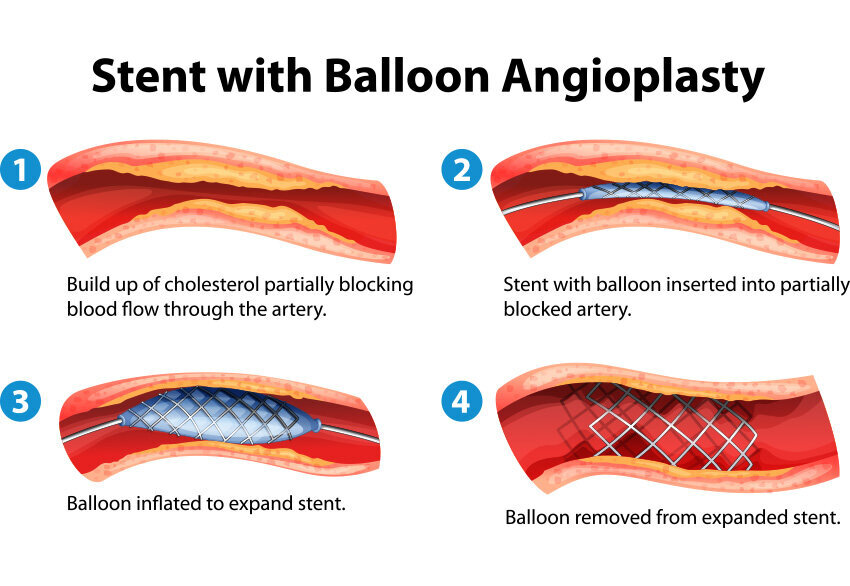 Angioplasty Stent Implantation Hurstville Private Heart Centre 