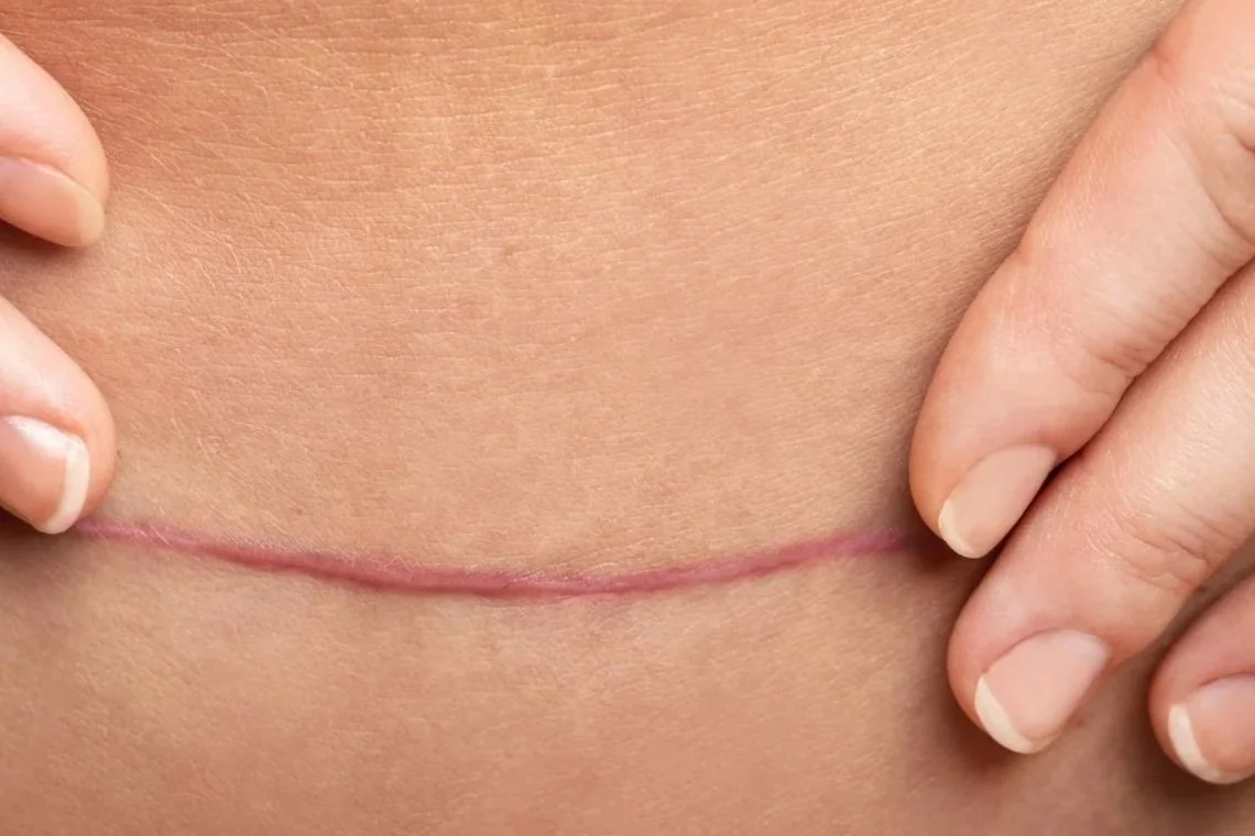 A scar on a persons body with their fingers running over   it