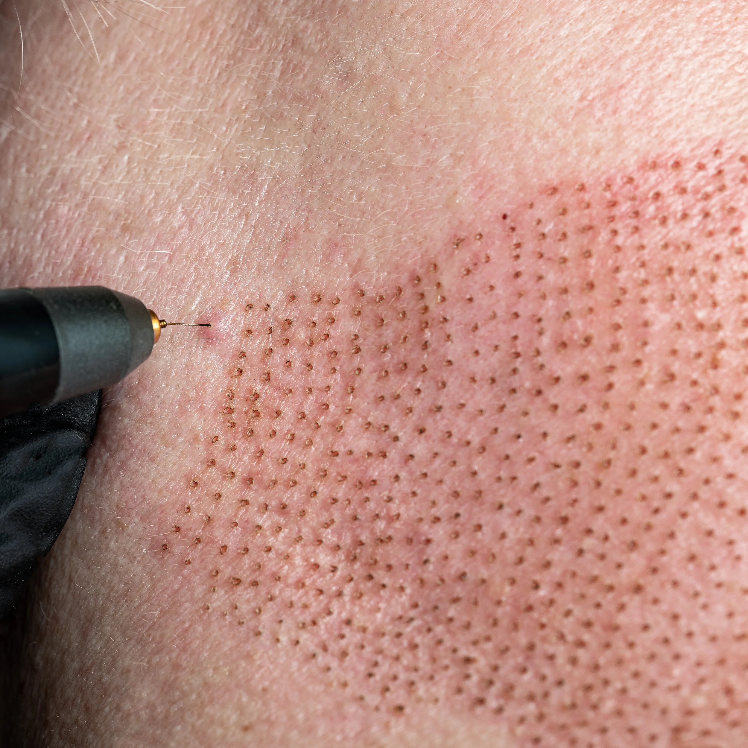 Plasma Pen Geelong — Bonny Skin Studio Geelong