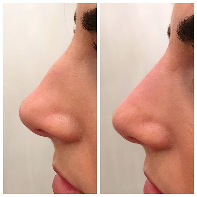 Liquid Rhinoplasty 👃🏼 Are you looking to straighten your nose, hide a bump, or change the size and shape of the nasal tip, but don&rsquo;t want to undergo the stress and cost of surgery? We can help!!
At Boost Your Beauty Medispa, we offer a NON-SU