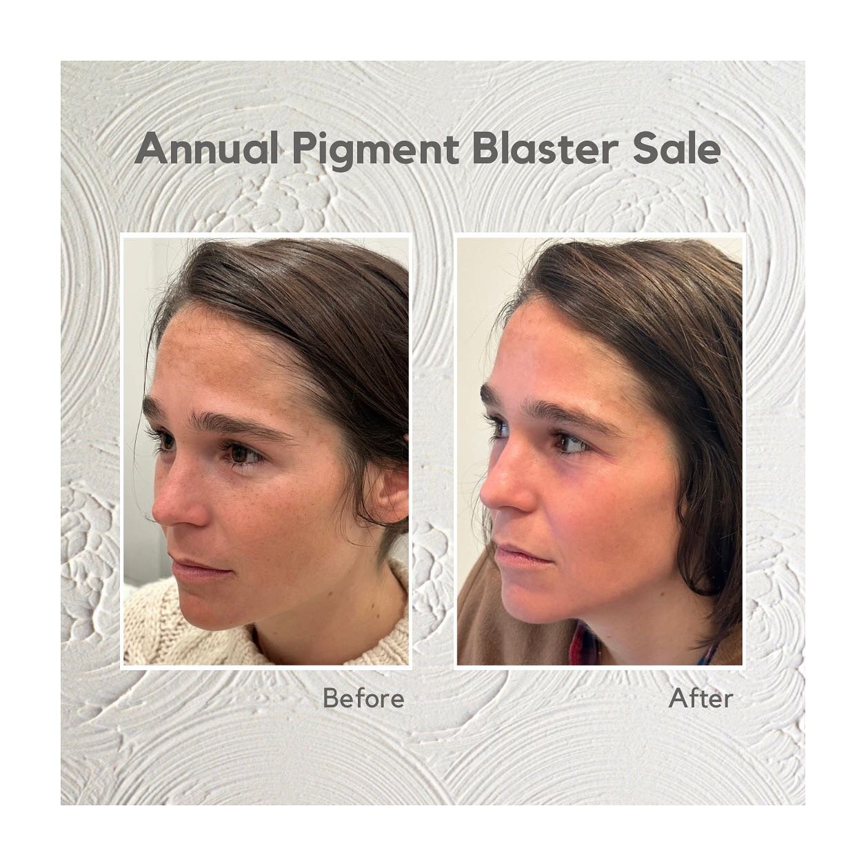 Annual pigment blaster special ☀️ 

🚨 Laser + Chemical Peel SALE 🚨 

20%-30% off during October and November (details below)

Goodbye sun damaged skin, hello dewy youthful glow. 

Purify your skin from another season of too much fun in the sun. Whe