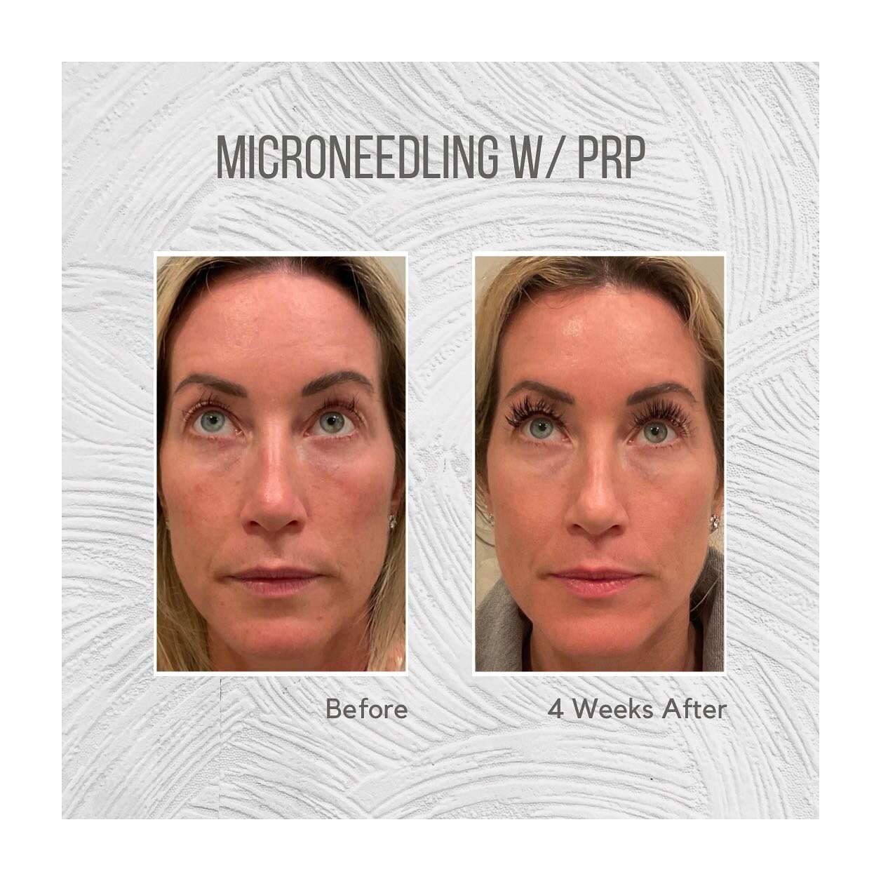 Microneedling May Special 🚨 

👉Save $150 (microneedling w/ PRP regularly $450). Month of May $300

⚡️ The Candela Exceed device offers enhanced treatment versatility as the first dual-indicated, FDA-cleared medical microneedling system for the trea