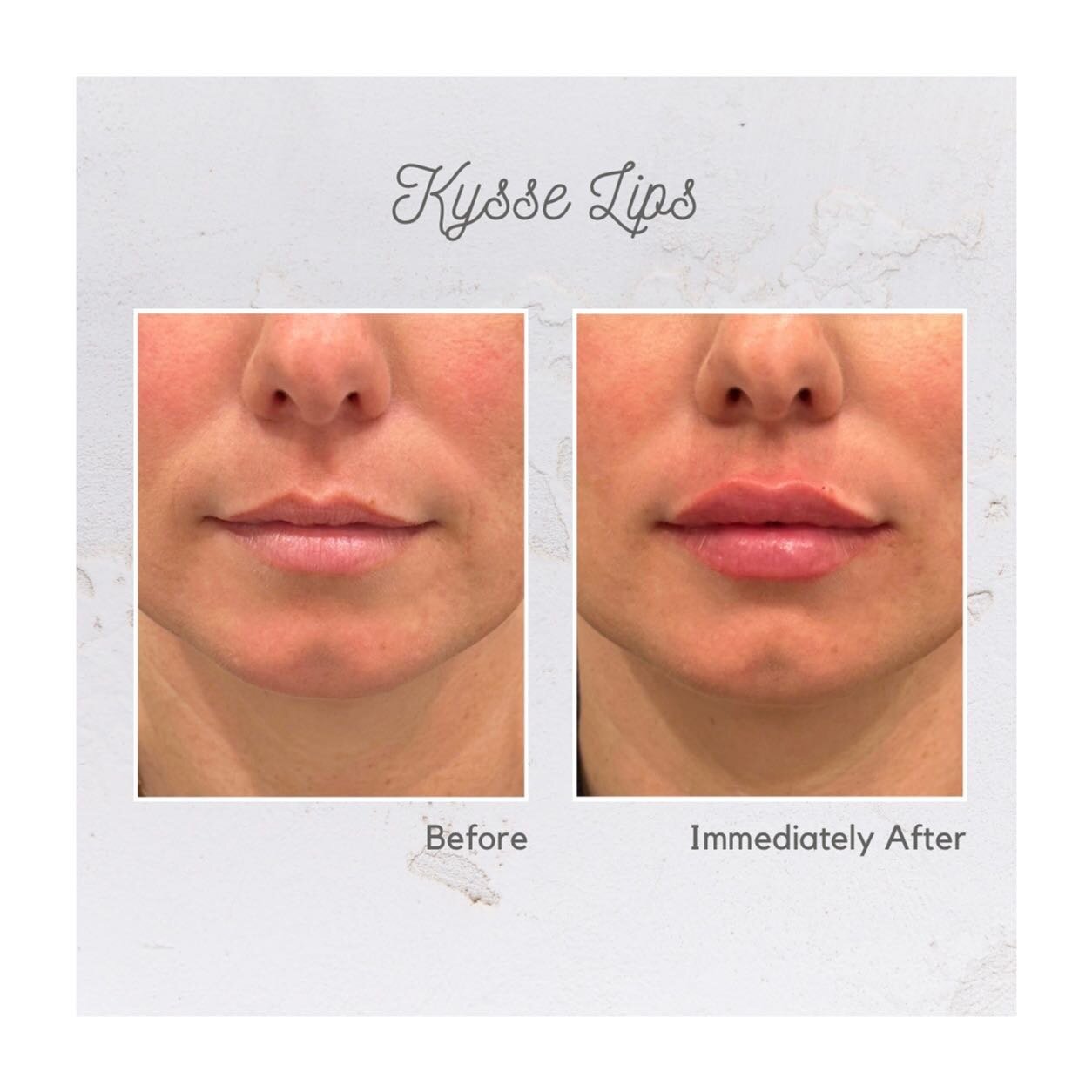 Kysse Lips 💉 👄 

Patients can expect moderate swelling immediately after injection. Oral arnica can be taken several days prior to an appointment to minimize both swelling and potential bruising. 

It&rsquo;s all part of the journey ✌️ 

📲 Book on