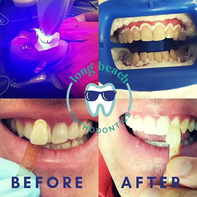 Whitening fun at the office! 😎🤓😁🦷
.
.
It's easy to get 3-4 shades brighter in one visit! Call us to schedule your smile makeover 🥰🥳 .
.
.
#longbeachdentist #longbeachorthodontist #longbeachorthodontics #longbeach #longbeachca #whitesmiles #happ