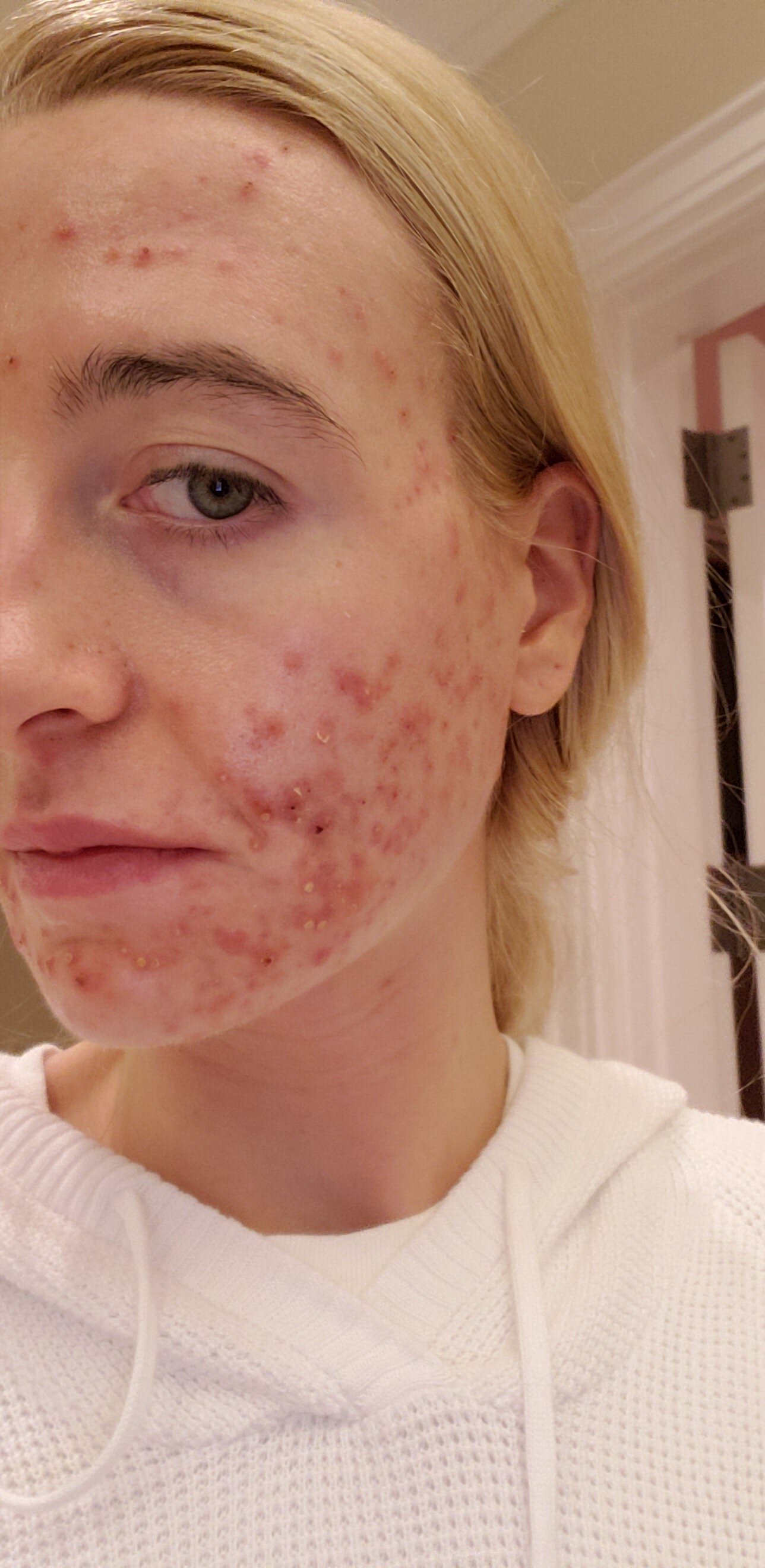 2 Week Journey on Accutane - Side Effects and Products — Crystal Clear By  Karisa