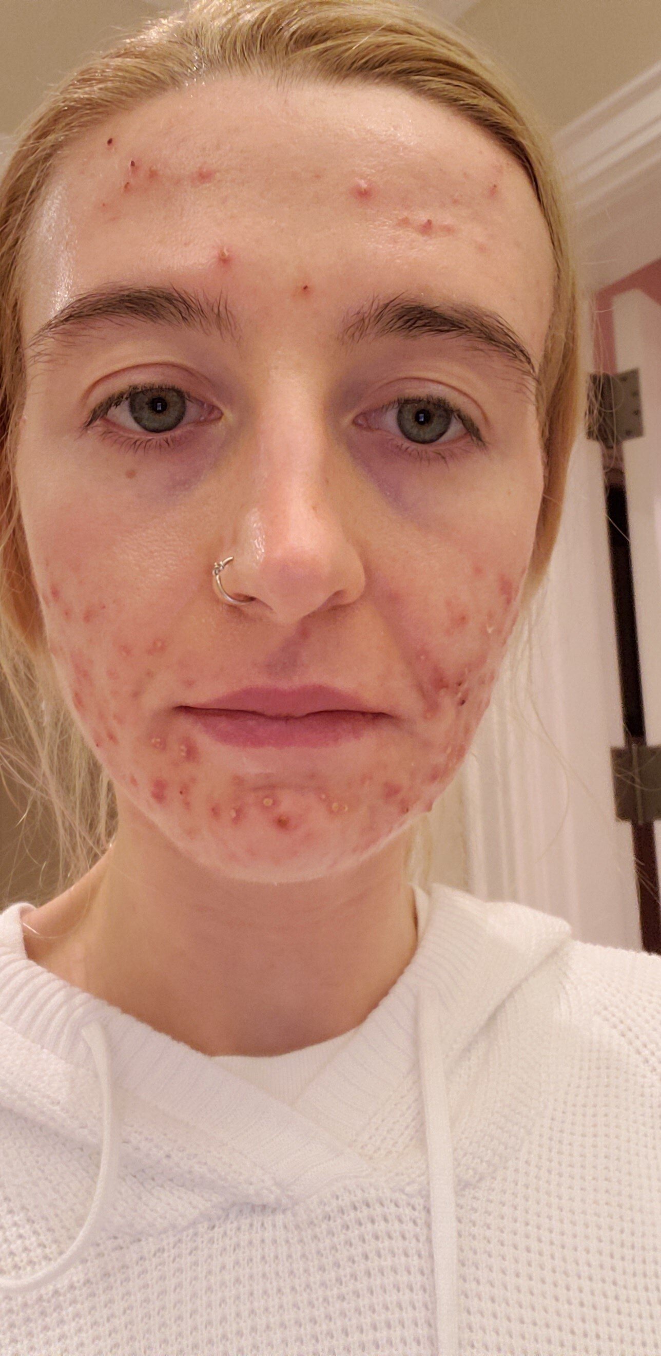 gør ikke Bevægelse Politik The Accutane Guide and the Gut, Health, and Acne Connection — Crystal Clear  By Karisa