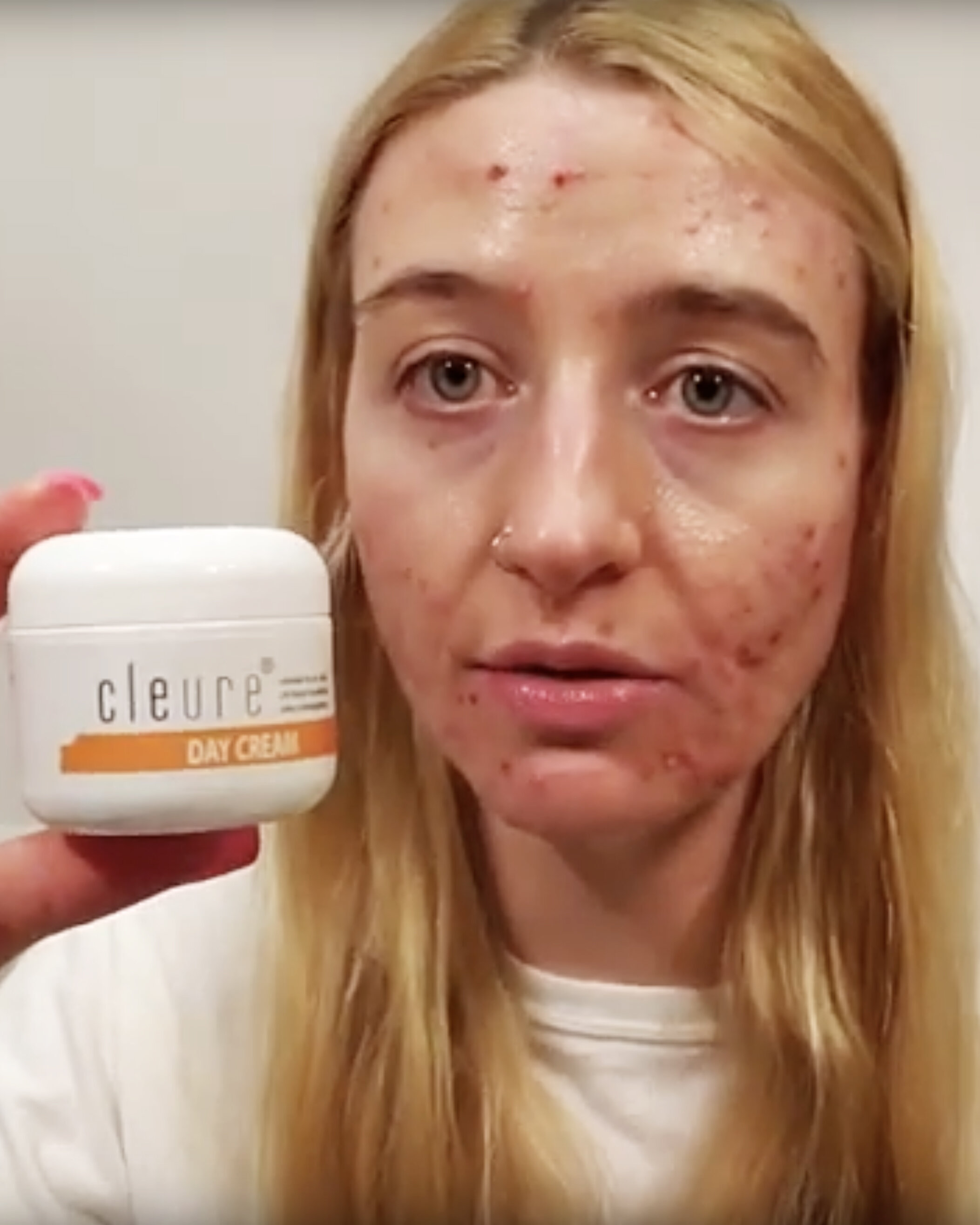 2 Week Journey on Accutane - Side Effects and Products — Crystal Clear By  Karisa