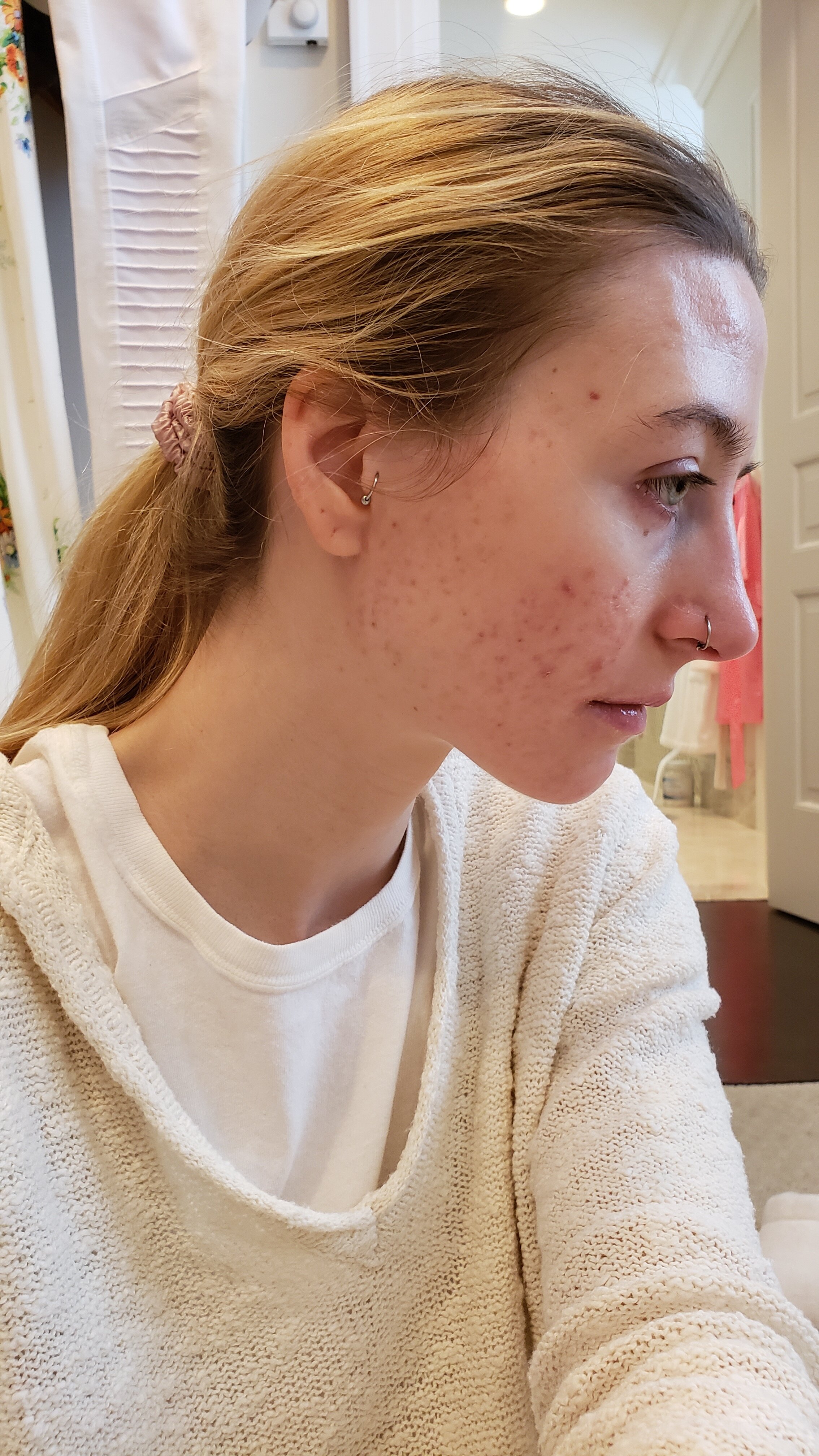 9 Month Accutane Transformation - Before & After Photos — Crystal Clear By  Karisa