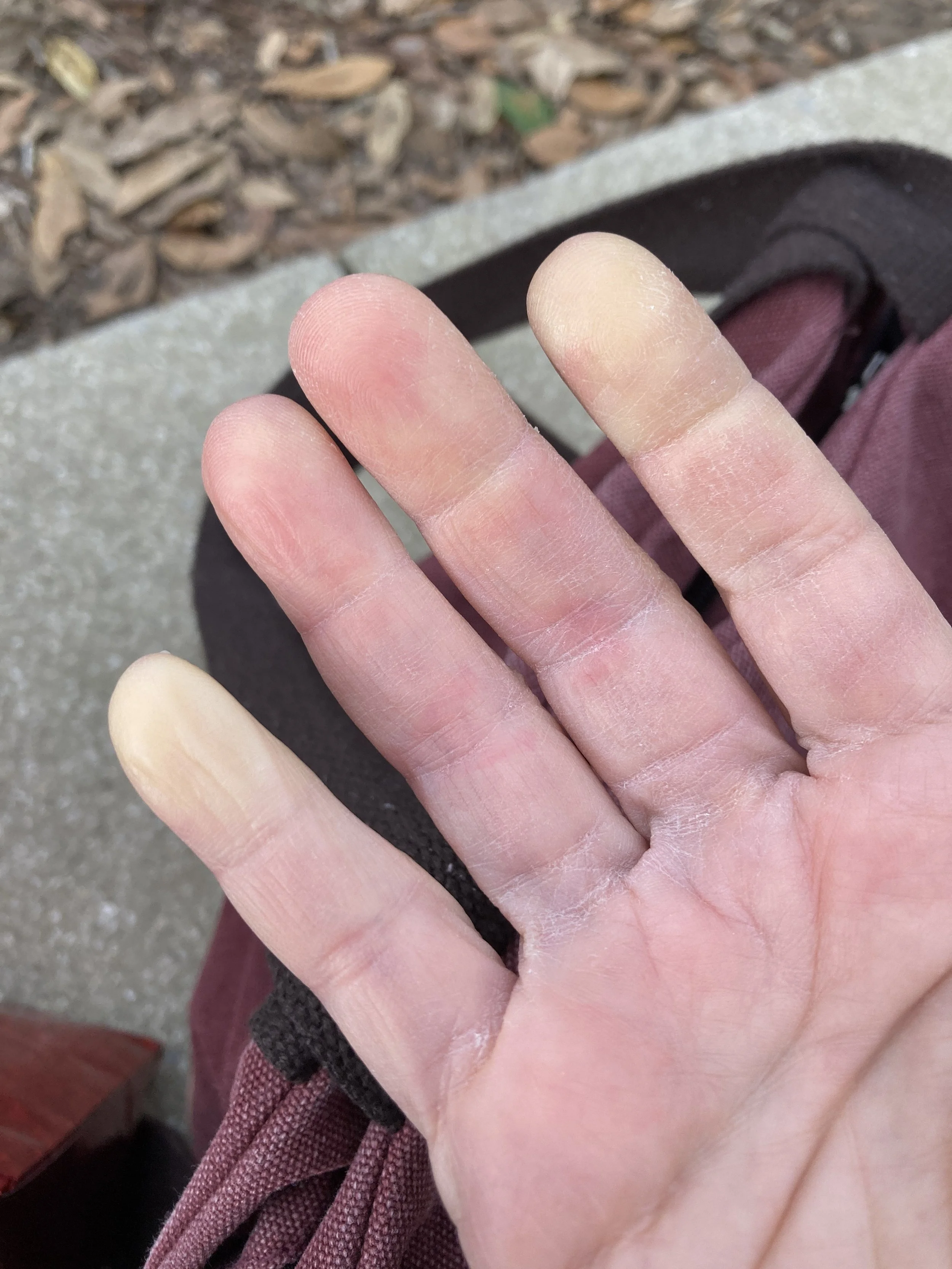 Egg Whites, TPO Antibodies, and Raynaud's 