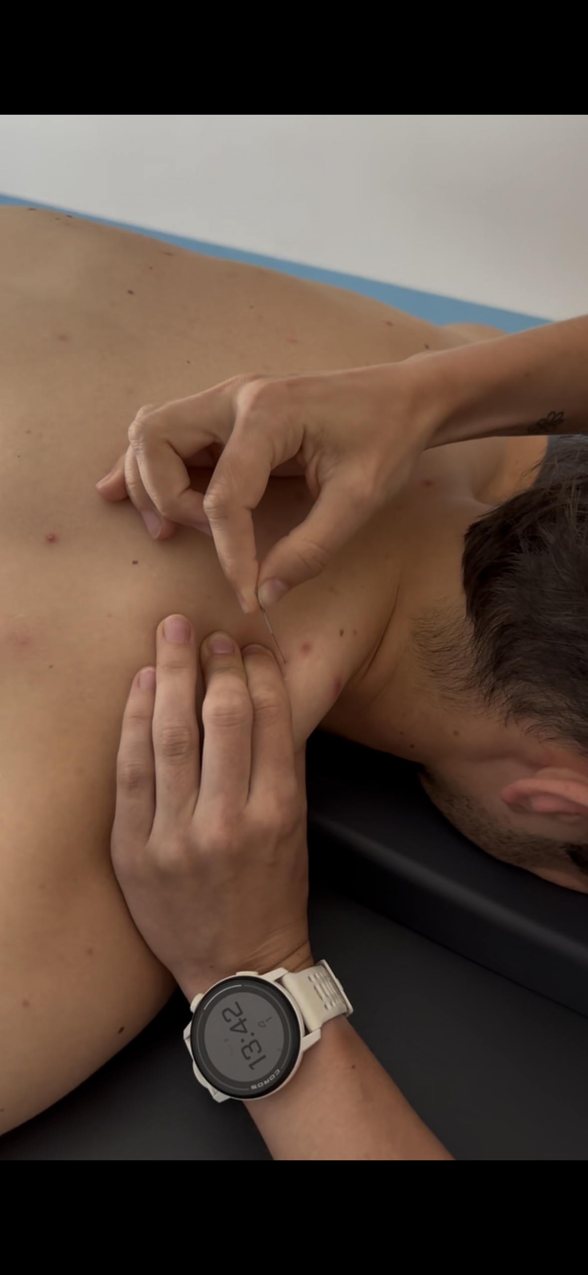 NEU bei Physio Bergauf: Dry Needling