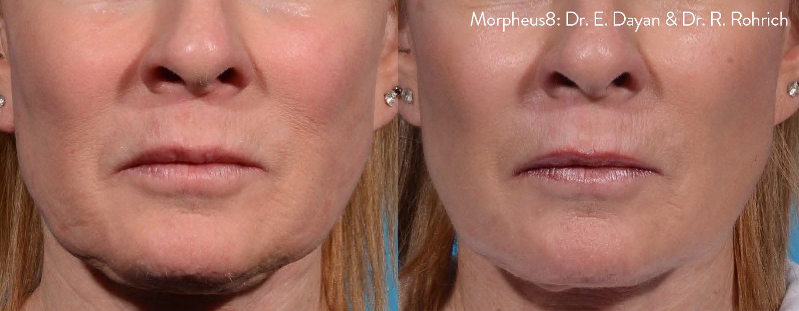 morpheus8-before-after-dr-e-dayan-dr-r-rohrich-preview-2.jpg