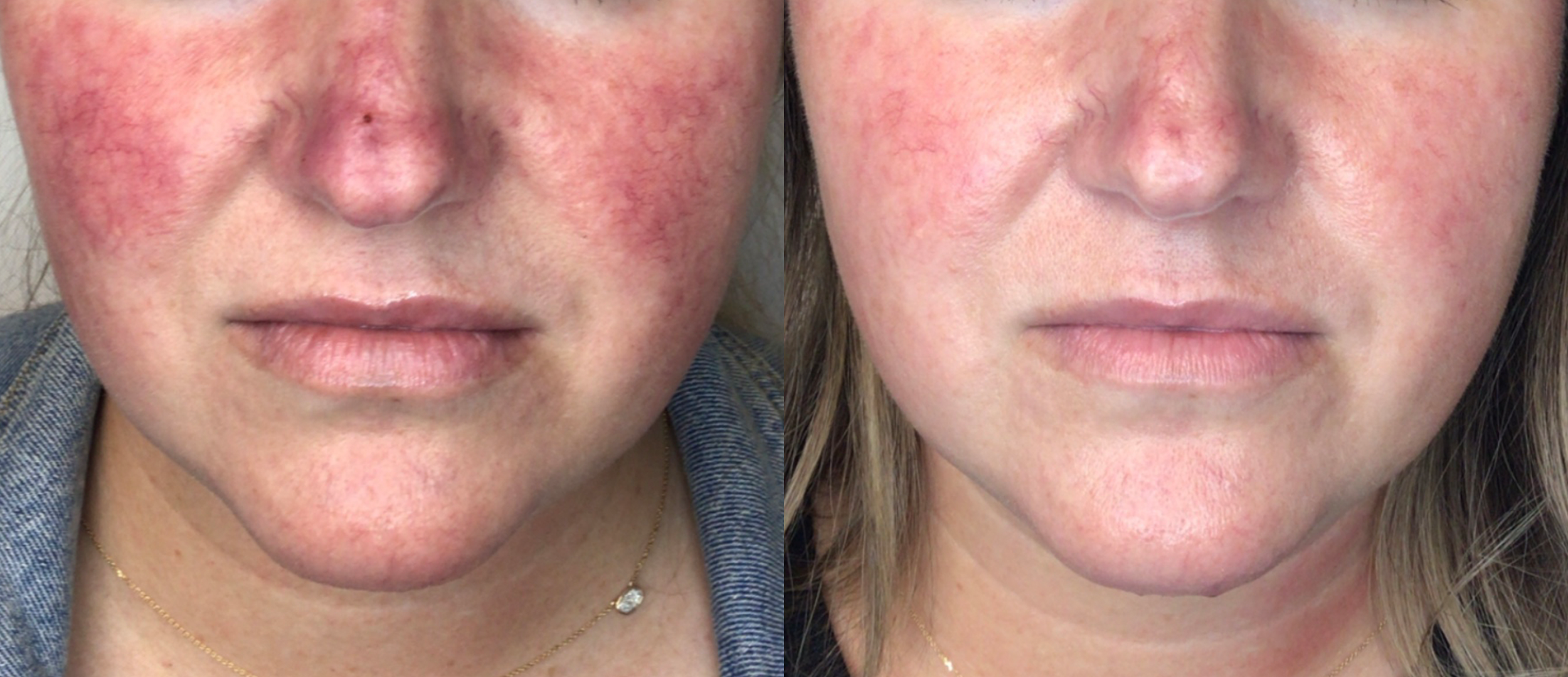 lumecca-before-after-spry-skin-and-wellness-preview-1.png