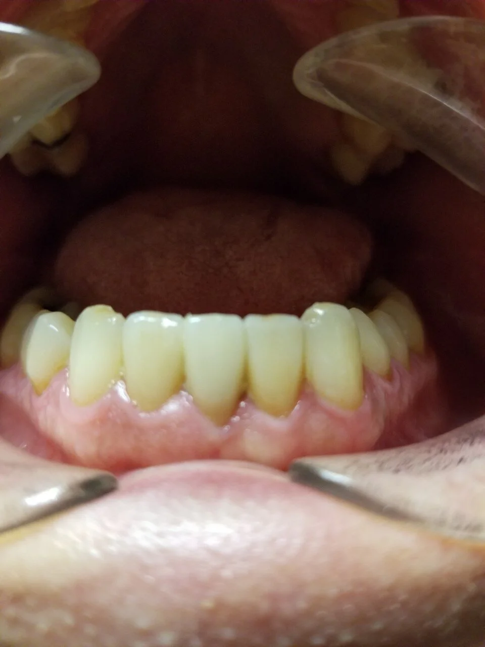 Cosmetic Dentistry After